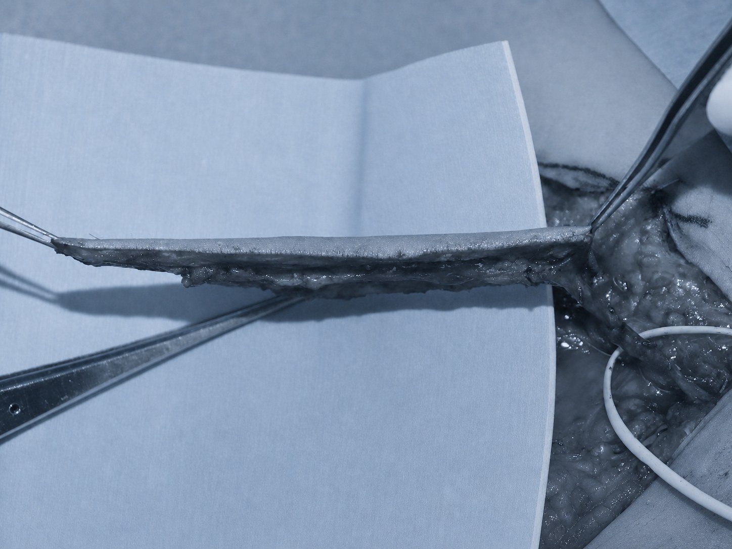 AI-edited side-view intraoperative photograph showing the thin profile of a PSP flap
